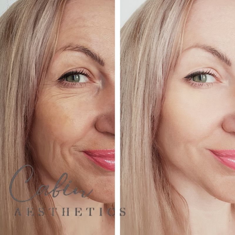 Cabin Aesthetics - Fat Reduction