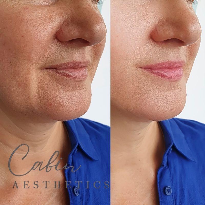 Cabin Aesthetics - Filler